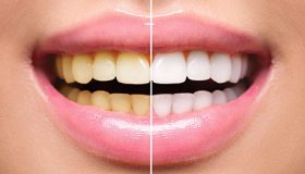 بلیچینگ دندان چیست؟ عوارض و فواید بلیچینگ دندان